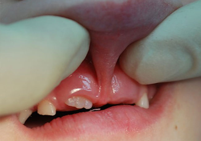 Короткая уздечка верхней губы у ребенка