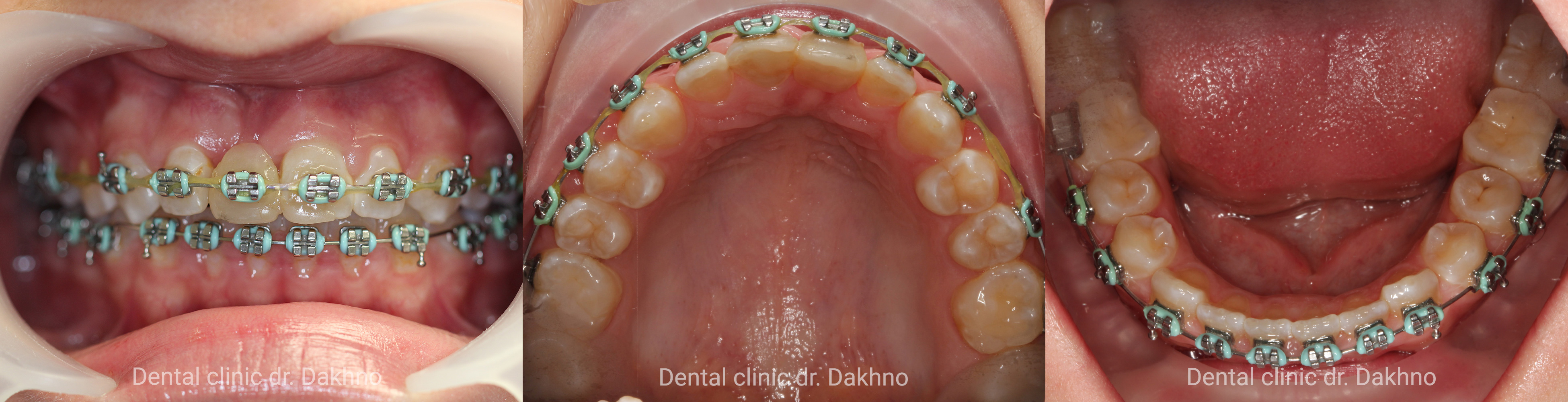 Завершение ортодонтического лечения